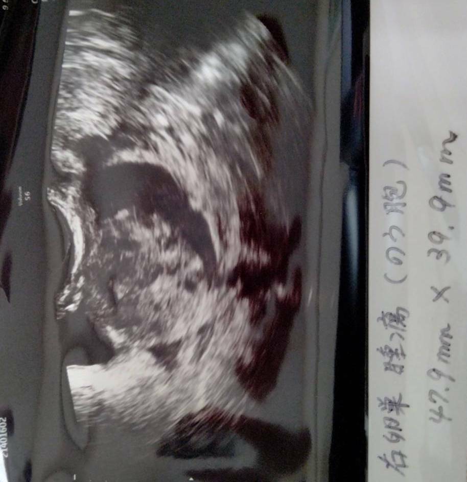 ゆりさんの質問 代女性です 昨日エコー検査で卵巣嚢腫が見つかり Peer Ring なかまと話そう 女性特有のがん