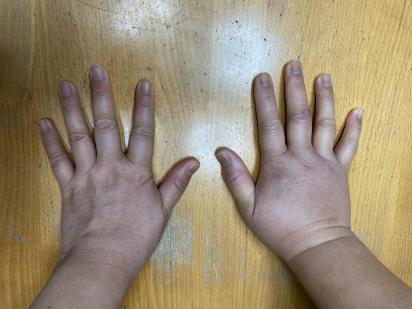 浮腫 Peer Ring なかまと話そう 女性特有のがん 浮腫 Peer Ring なかまと話そう 女性特有のがん