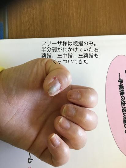 爪 Peer Ring なかまと話そう 女性特有のがん