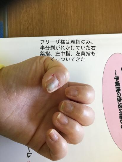 爪 Peer Ring なかまと話そう 女性特有のがん 爪 Peer Ring なかまと話そう 女性特有のがん